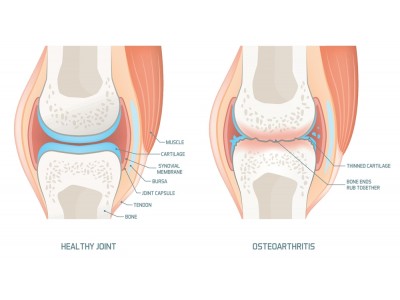 Managing Severe Osteoarthritis Without Medication