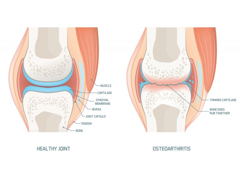 Managing Severe Osteoarthritis Without Medication