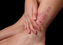 Prevention of red spots on legs
