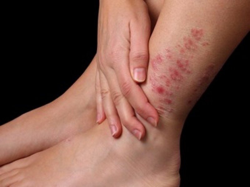 Prevention of red spots on legs
