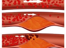 Signs of atherosclerosis