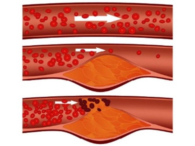 Signs of atherosclerosis