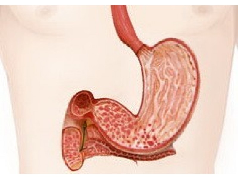 Treatment of gastroduodenitis