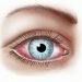 Conjunctivitis — the most common eye disease