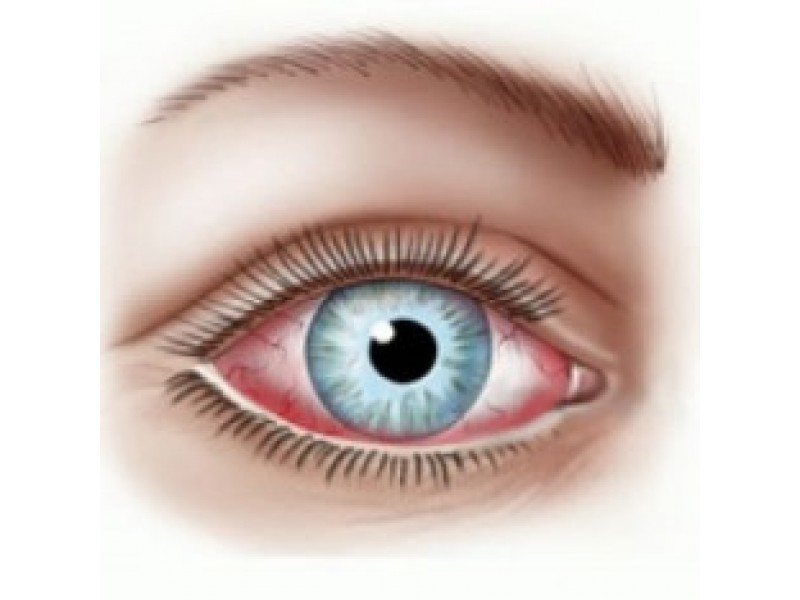 Conjunctivitis — the most common eye disease