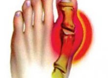 Gout is the most common metabolic disorder