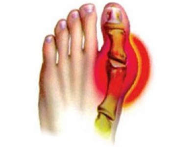 Gout is the most common metabolic disorder
