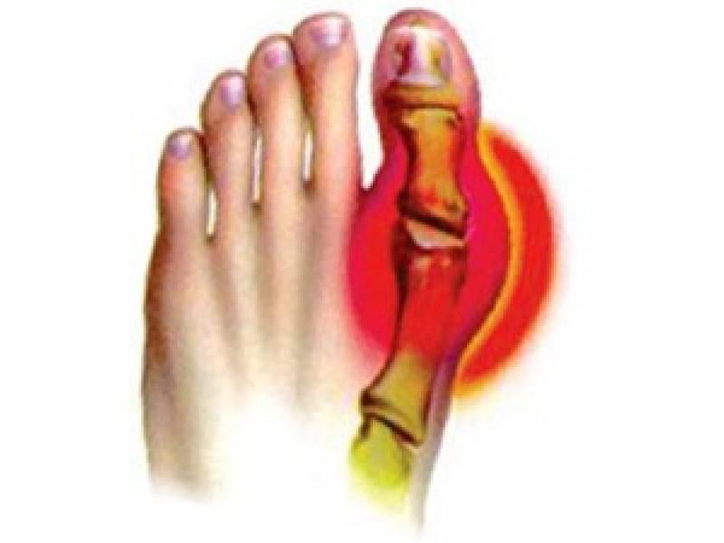 Gout is the most common metabolic disorder