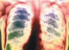 Is tuberculosis still a dangerous disease?