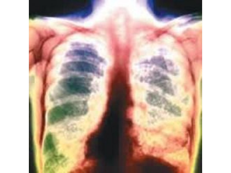 Is tuberculosis still a dangerous disease?